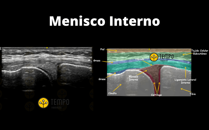 7. Menisco Interno Ecografia Tempo Formacion.png